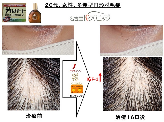 円形脱毛症　病院